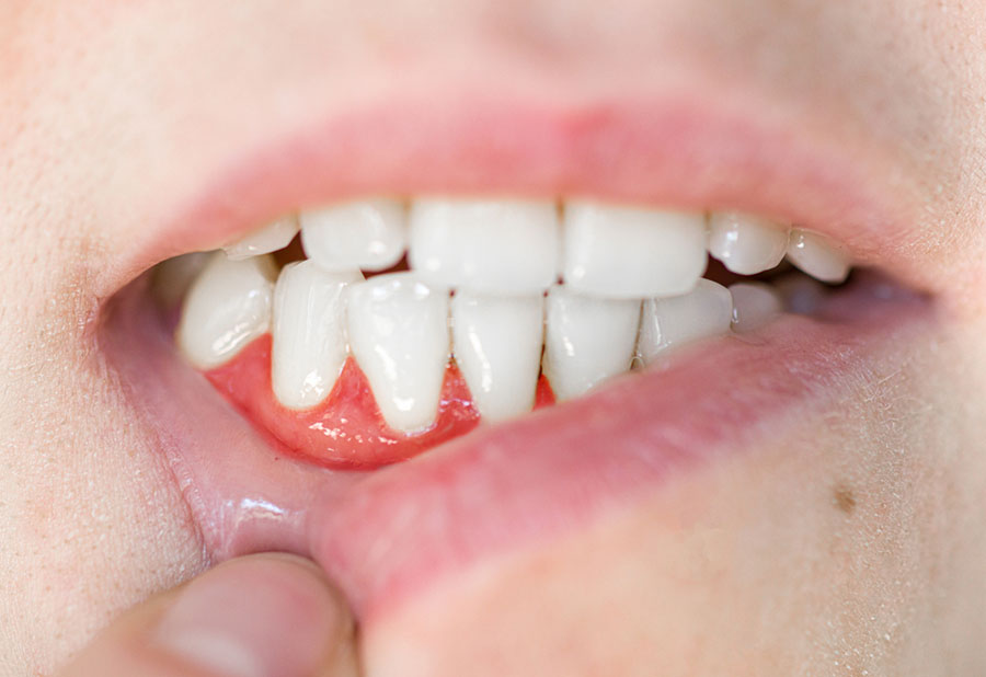 Nguyên nhân gây viêm chân răng