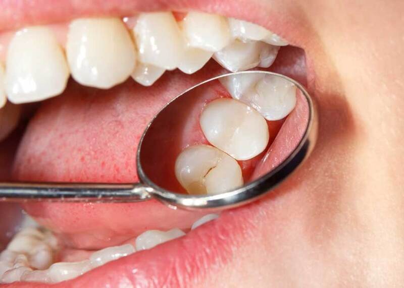 Nên làm gì để ngăn ngừa răng sâu?
