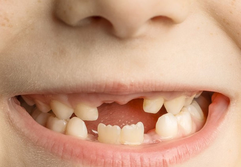 Sún răng là gì?