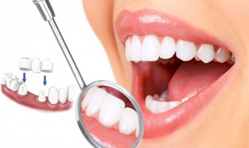 Giải pháp phục hình răng cửa thẩm mỹ và ổn định nhất 