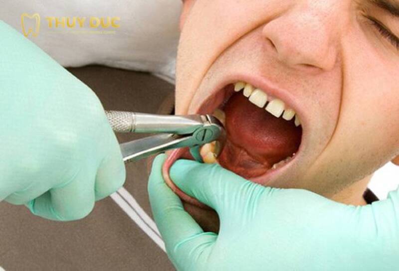 Nhổ răng khôn có đau không? Đau bao nhiêu ngày? 