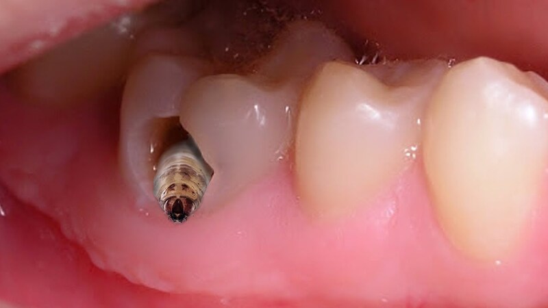 Con sâu răng trông thế nào?
