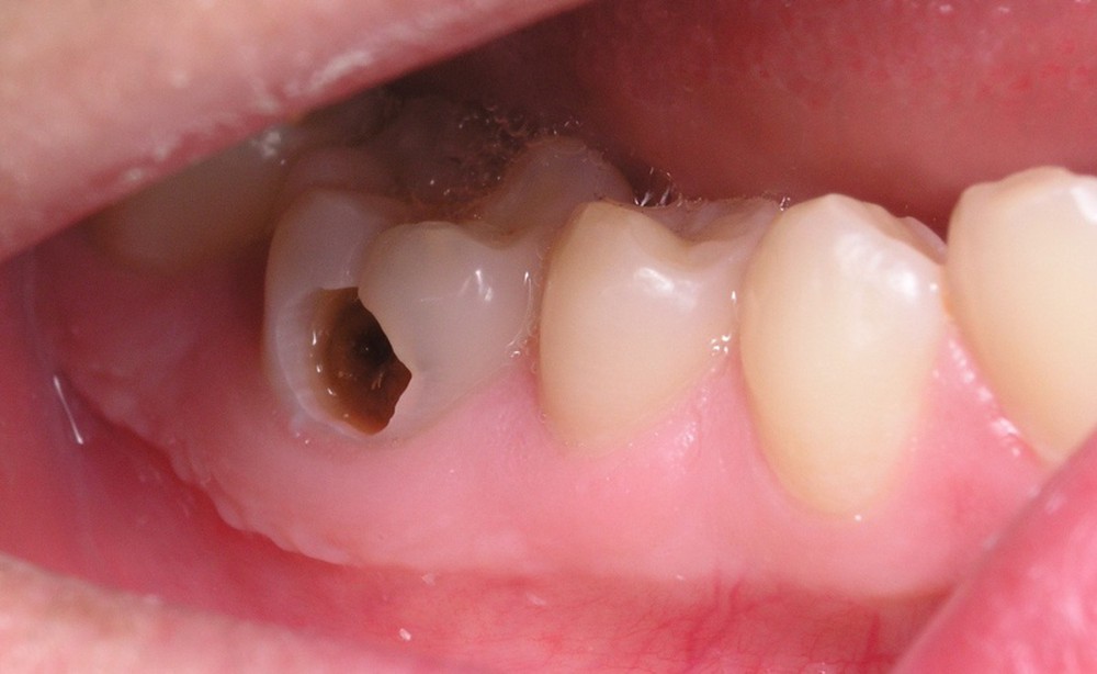  2. Gây tổn thương thậm chí chết tủy răng 