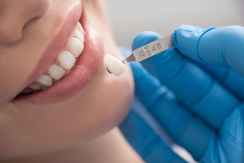  Bọc răng sứ có bền không? 