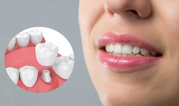 Những lợi ích của bọc răng sau khi lấy tủy