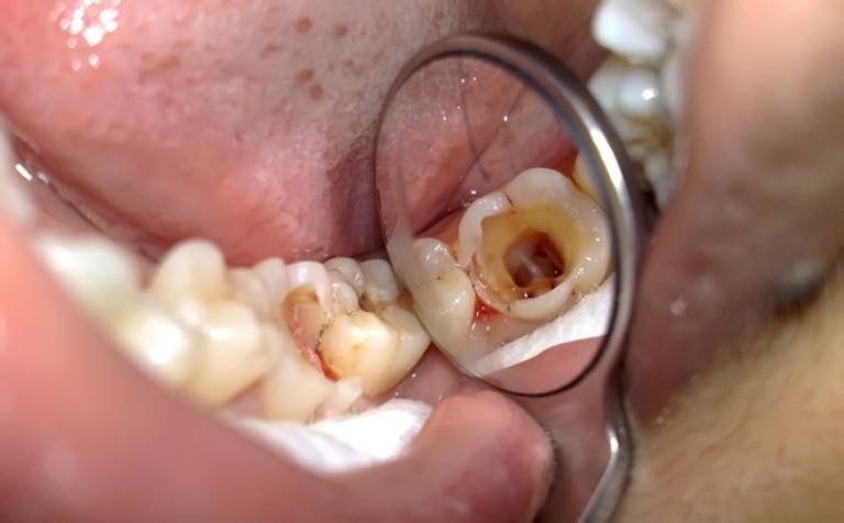  4. Gây nhiều bệnh lý răng miệng 