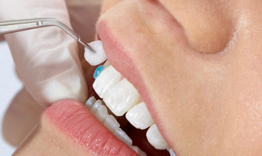 Lấy tủy khi bọc răng sứ có ảnh hưởng gì không?
