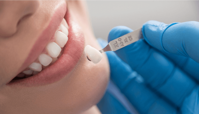 Bước 3: Thực hiện phục hồi hình dạng cho răng sứ