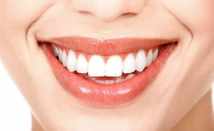 Các phương pháp bọc răng sứ kiểu răng thỏ tròn nha khoa