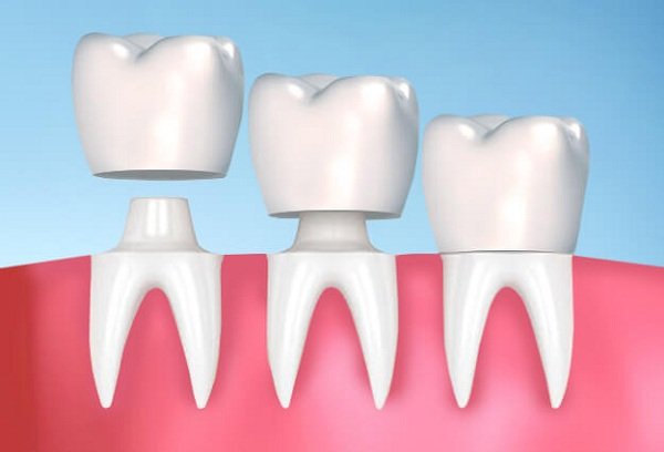 Chi phí trồng răng sứ giá rẻ nhất là bao nhiêu?