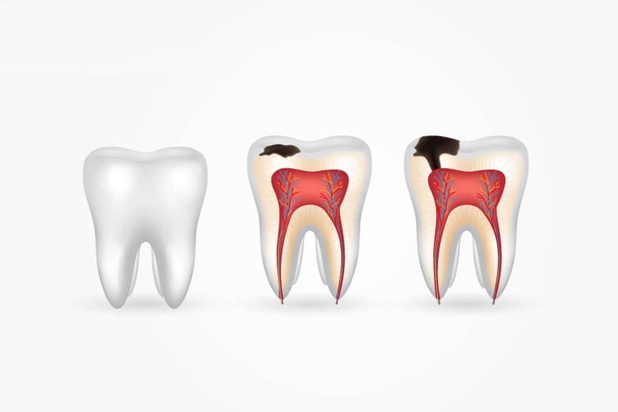 Dấu hiệu viêm tủy răng thông qua các giai đoạn