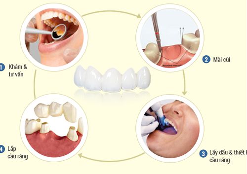  Quy trình bọc răng sứ như thế nào?