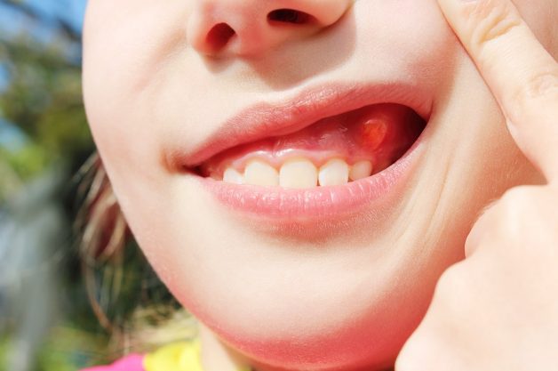 Hiện tượng áp xe răng là gì