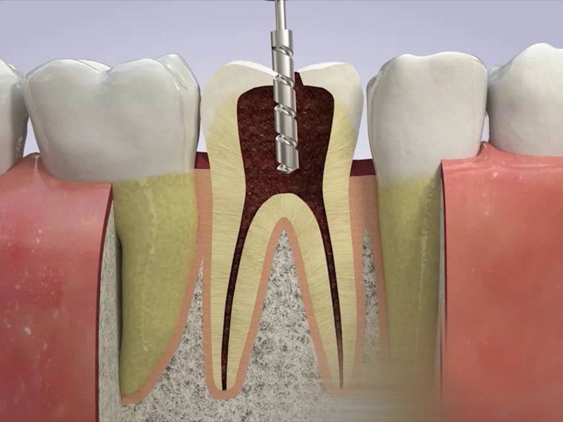  Lấy tủy khi bọc răng có ảnh hưởng gì không? 