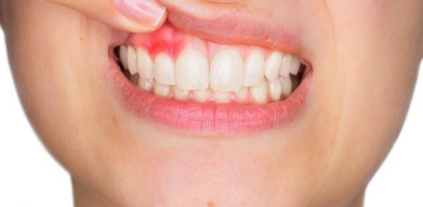 Triệu chứng ung thư nướu răng
