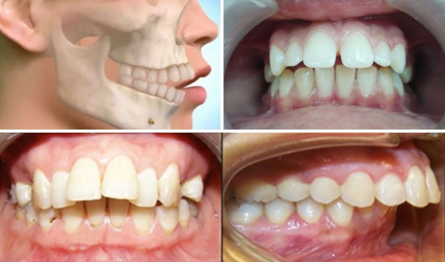 Những trường hợp nào thì nên bọc răng sứ 2 răng cửa bị hô?