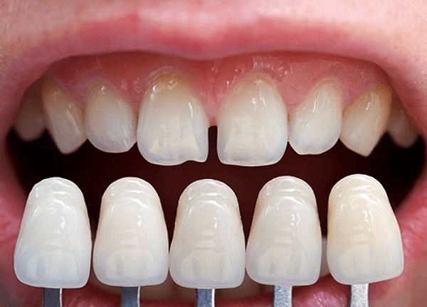 Những ưu điểm của việc phủ sứ răng mà các bạn cần biết