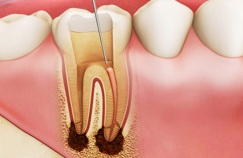 Quy trình của bọc răng sứ khi chữa tuỷ như thế nào?