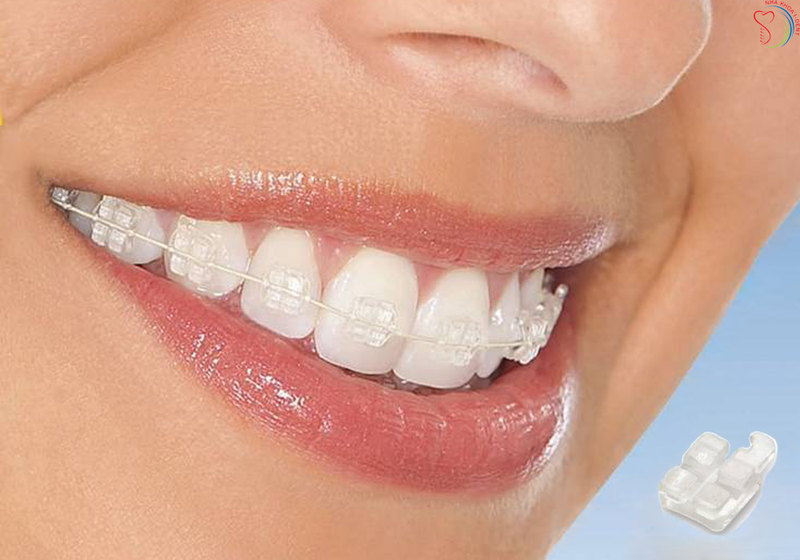 Quy trình niềng răng mắc cài loại sứ thế nào?