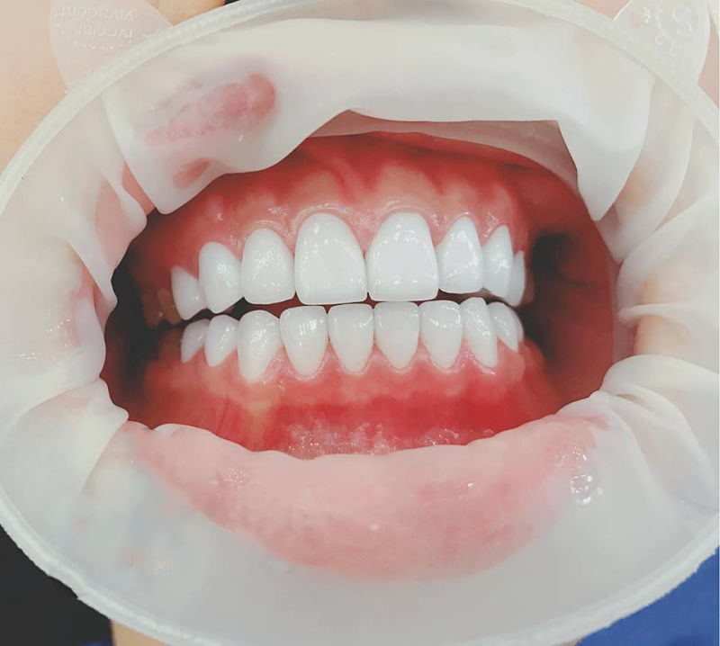 Răng bọc sứ bị đau nhức thì phải làm gì?