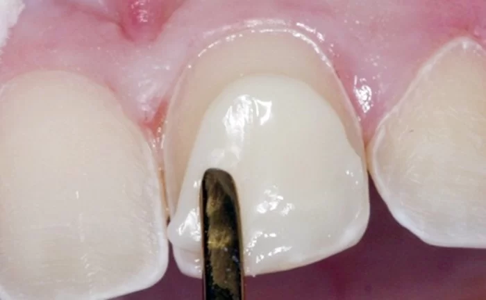 Trám răng Composite 