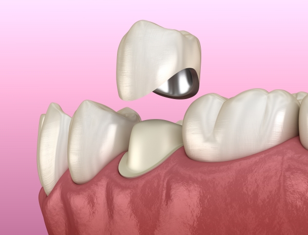  Trường hợp nào bọc răng sứ không cần lấy tủy? 
