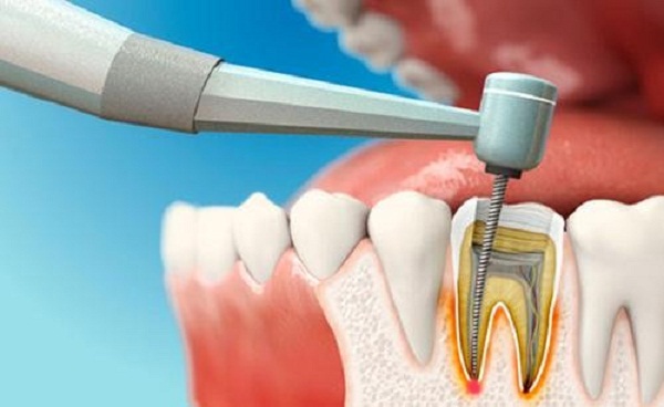 Tuỷ răng sứ được hiểu là gì?