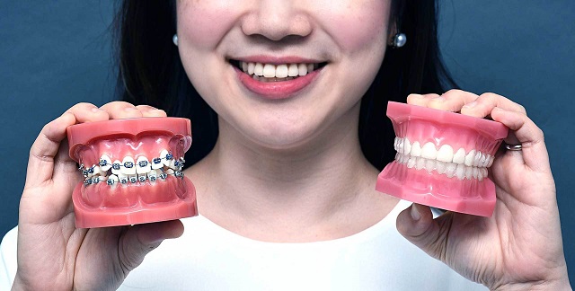 Bọc răng sứ và niềng răng cần lưu ý điều gì? 
