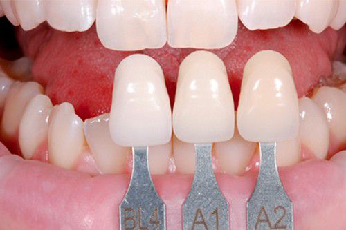 Bọc răng sứ có đau không? 