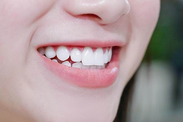  Vì sao bọc răng sứ được ưa thích? 