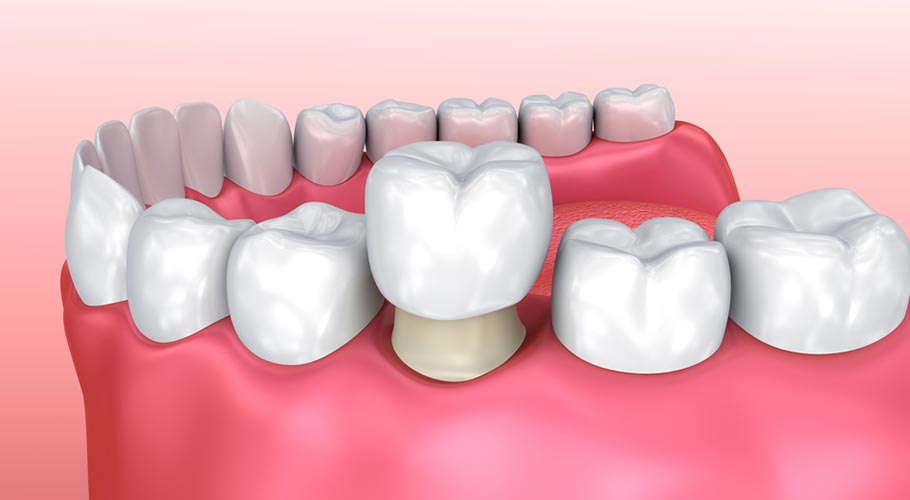 Tìm hiểu về phương pháp bọc răng sứ 