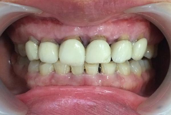 Những rủi ro có thể xảy đến nếu bạn chọn loại răng sứ giá rẻ 