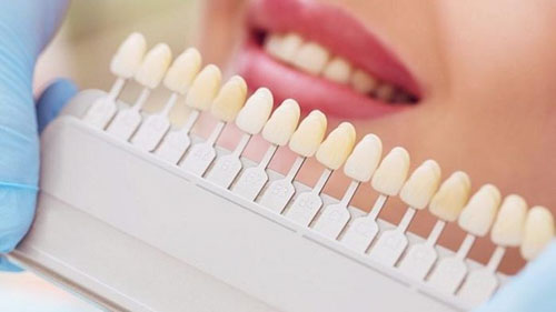 Cách chọn bảng màu răng sứ đẹp tự nhiên 