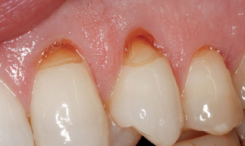 Mô răng còn nhiều hoặc ít 