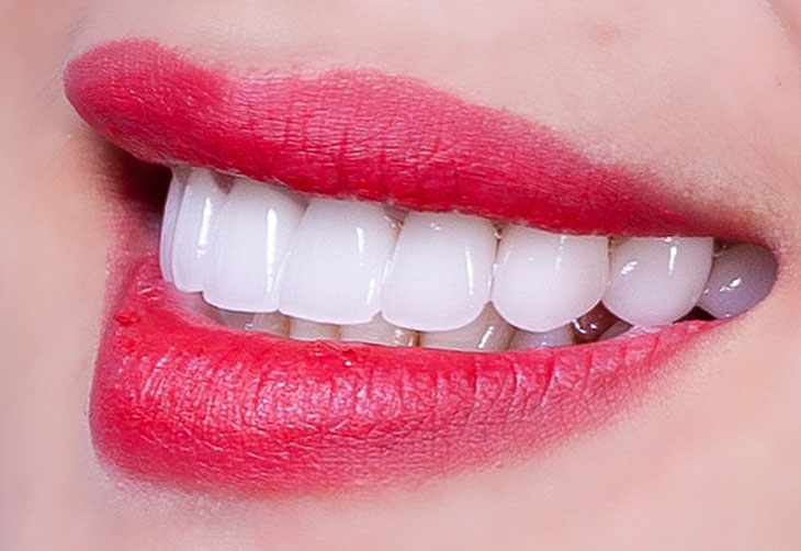 Vậy có nên bọc răng sứ thẩm mỹ không? 