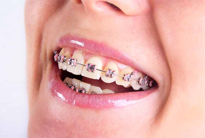  Ưu điểm của phương pháp niềng răng