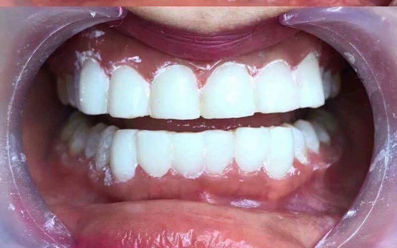 phủ sứ răng