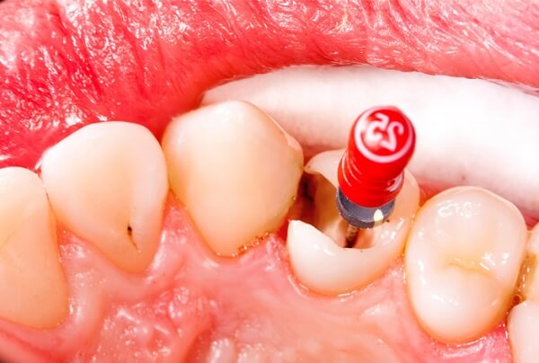  Bọc sứ cho răng hỏng, răng chữa tủy 