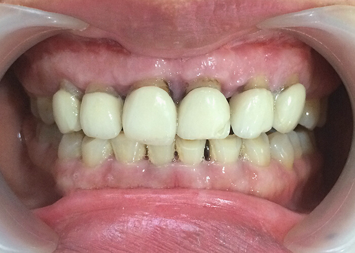  Răng sứ kim loại bị oxy hoá do quá trình sử dụng dẫn đến hôi miệng 
