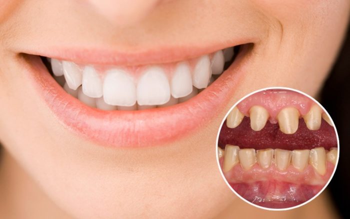 Phương pháp bọc răng sứ là như thế nào? 