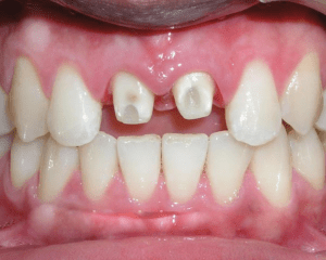 tác hại của bọc răng sứ