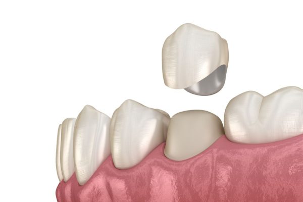Ưu điểm của phương pháp bọc răng sứ 