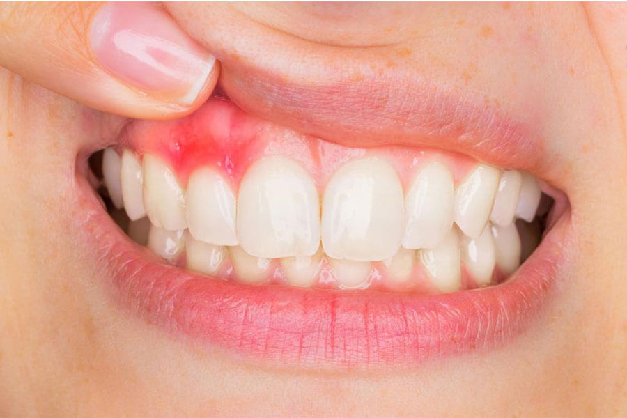  Bọc răng sứ có ảnh hưởng gì không?