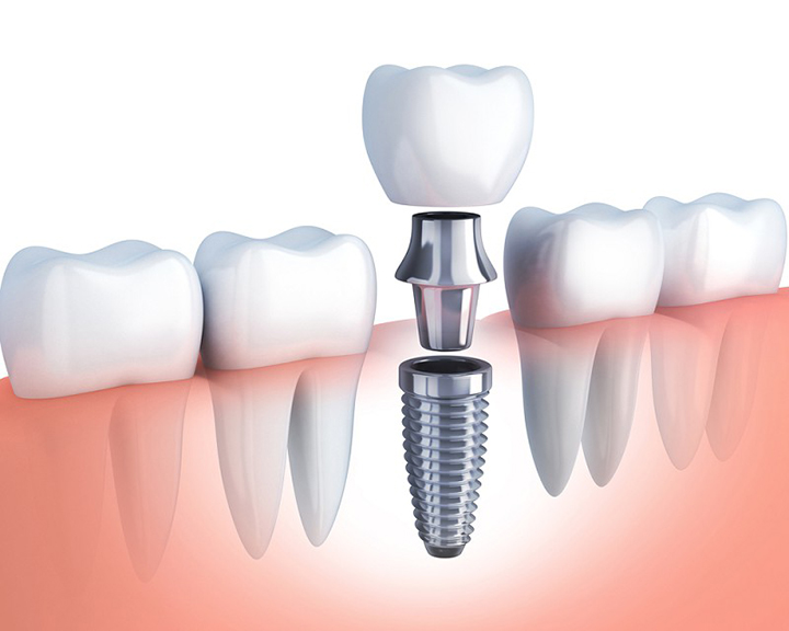 Trồng răng sứ không có chân răng và cấy ghép Implant 