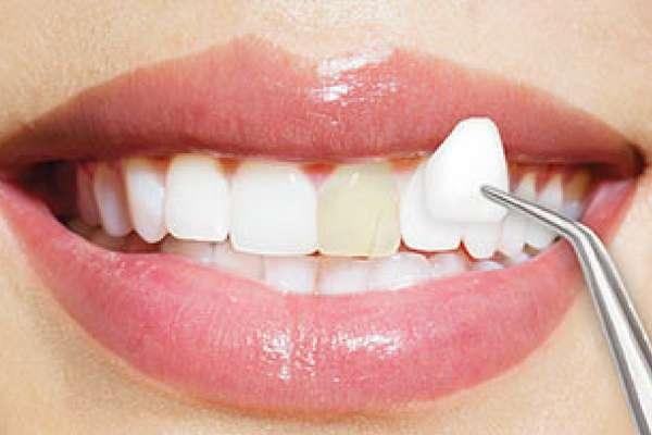  Làm răng sứ có đau không? 