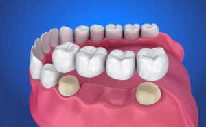 Trồng răng sứ thẩm mỹ bằng phương pháp làm cầu răng
