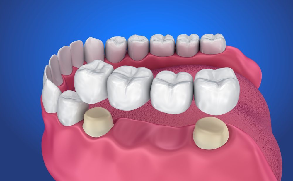 Trồng răng sứ thẩm mỹ bằng phương pháp làm cầu răng