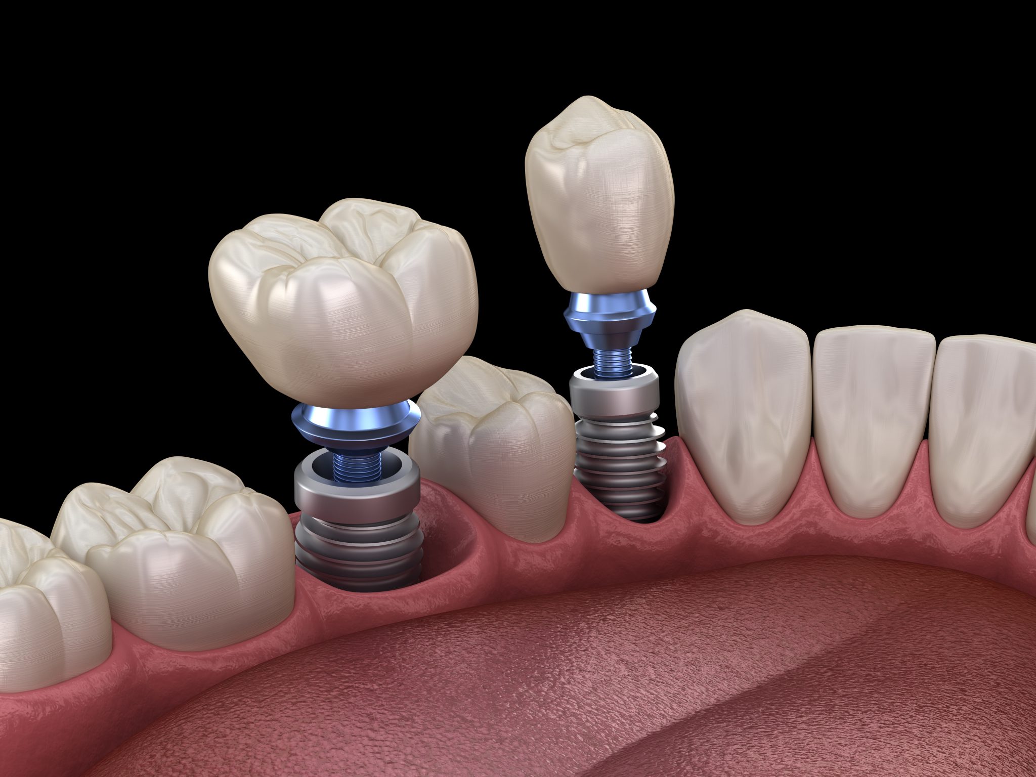 Trồng răng implant Osstem là gì