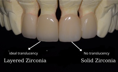răng sứ zirconia có giá bao nhiêu