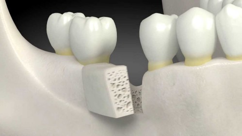 Ghép xương răng là gì